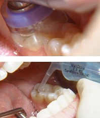Ozonoterapia stomatologiczna